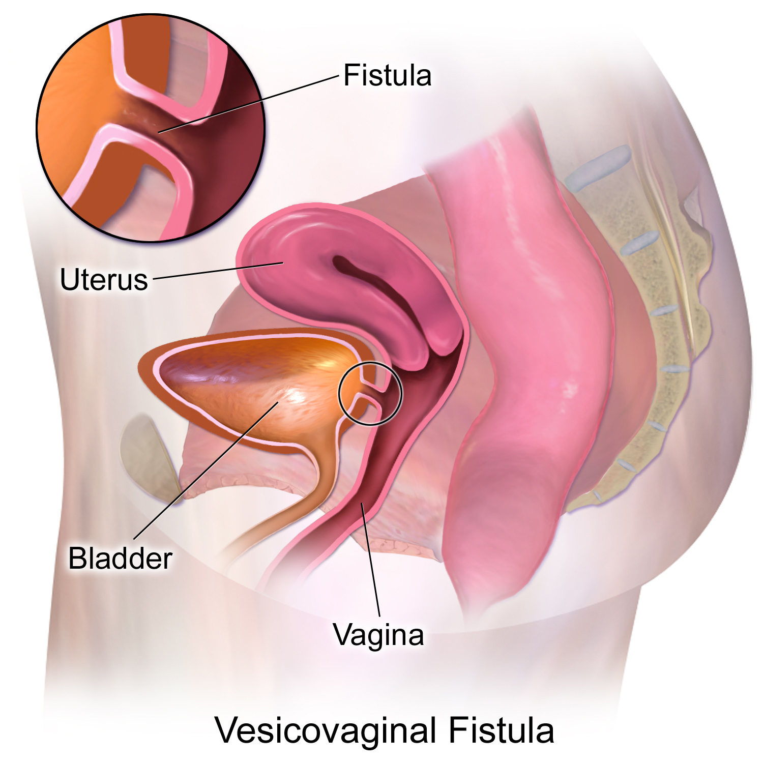 The Ningi Centre for Vesicovaginal Fistula (VVF) Disease
